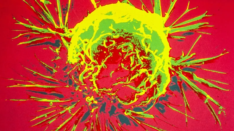 Paraguassu FM 87.9 — Conheça a síndrome de Li-Fraumeni Uma investigação conduzida pela EBU Investigative Journalism Network, consórcio de jornalismo investigativo da European Broadcasting Union, revelou um caso sem precedentes na reprodução assistida: o sêmen de um único doador dinamarquês foi usado durante 17 anos em 67 clínicas de 14 países, resultando em pelo menos 197 crianças — ultrapassando [&hellip;]